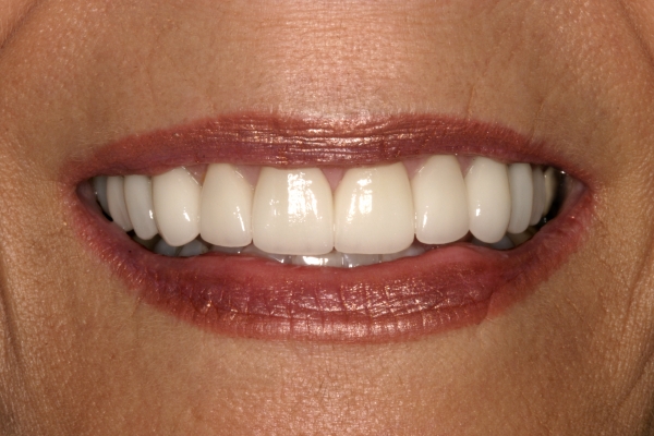 Close Up Complete Smile Makeover Patient After-Shelley