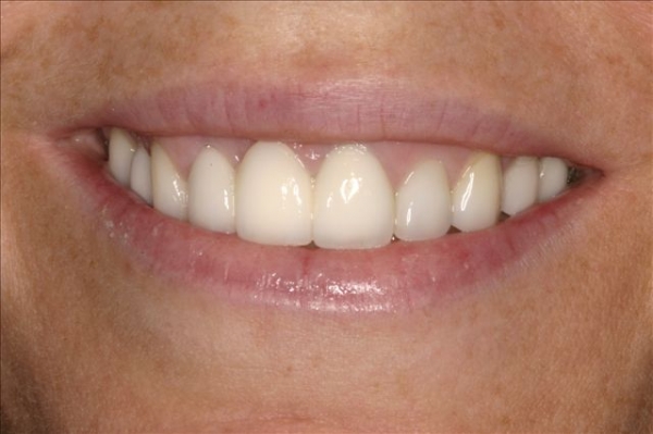 Close Up Smile Makeover Patient After- Rachel