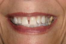 Close Up Complete Smile Makeover Patient Before-Shelley