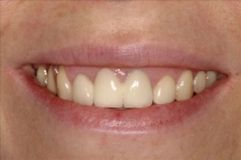 Close Up Smile Makeover Patient Before - Rachel