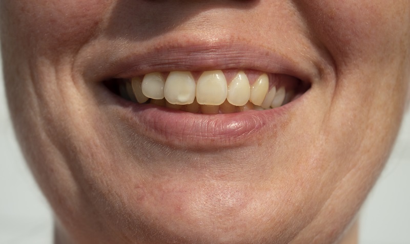 White spots on teeth before non-invasive treatment